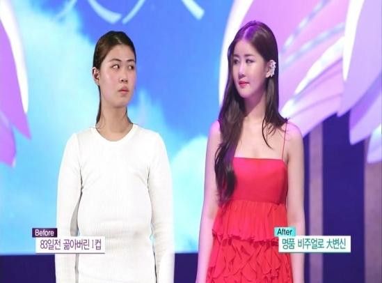 Cô gái Hàn thành hot girl sau khi phẫu thuật mặt và bộ ngực chảy xệ 23cm