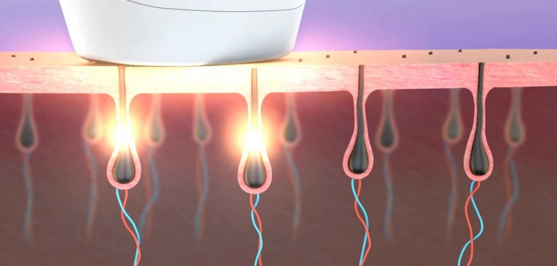 Đánh giá: Có nên mua máy triệt lông Rio?